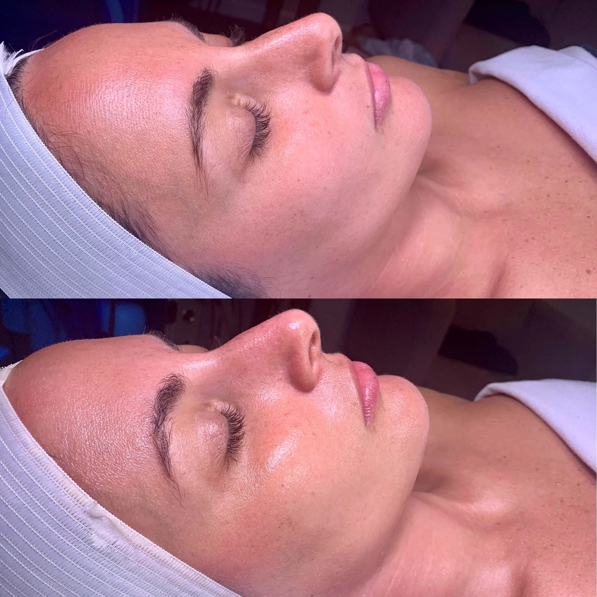 HydraFacial - Brightening Booster | The Steele Vault | Holladay, Utah