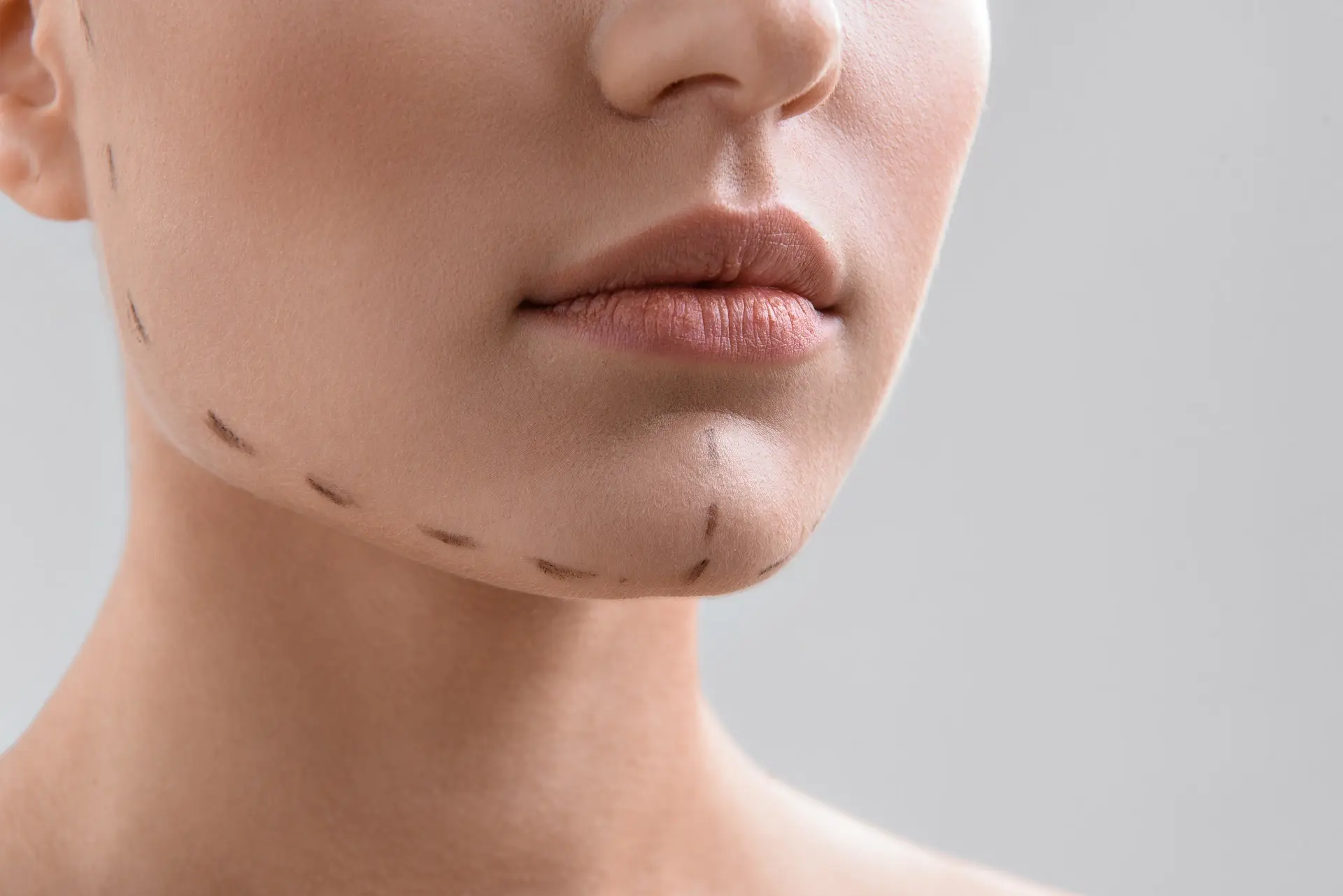 Kybella™ Treatment in Holladay, Utah | The Steele Vault