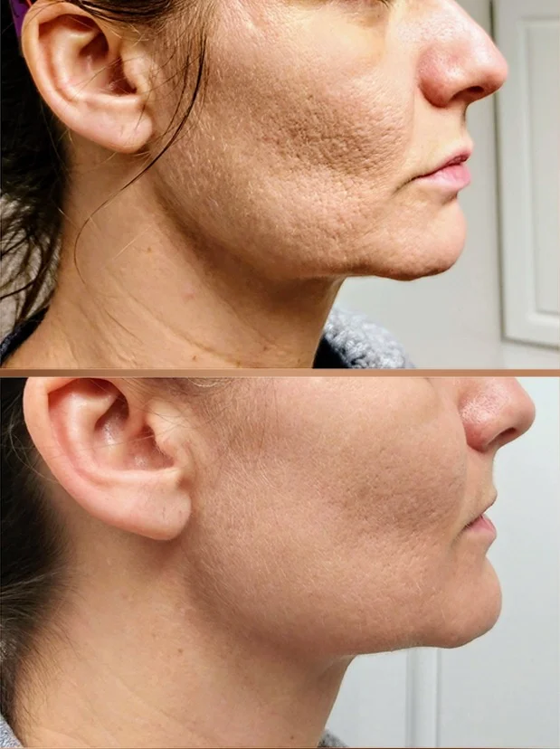 Scarlet SRF - Acne Scarring & Tightening | The Steele Vault | Holladay, Utah